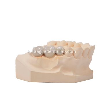 zirconia porcelain fused ກັບເຮືອນຍອດໂລຫະ